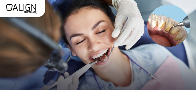 What does gum line cavity mean?