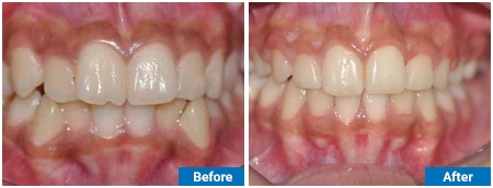ORTHODONTIC BRACES