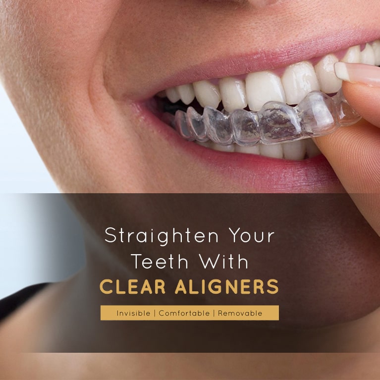 Invisalign in Sri Lanka Invisible braces in Dehiwala