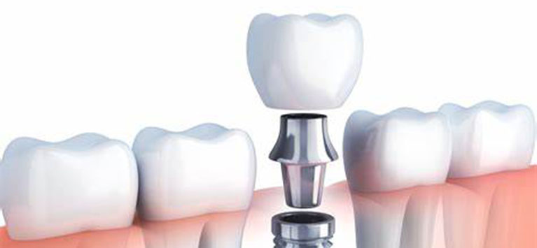 Dental Implants