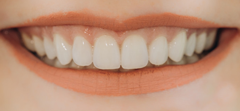 smile with veneers