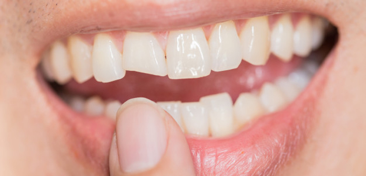 girl with chipped tooth