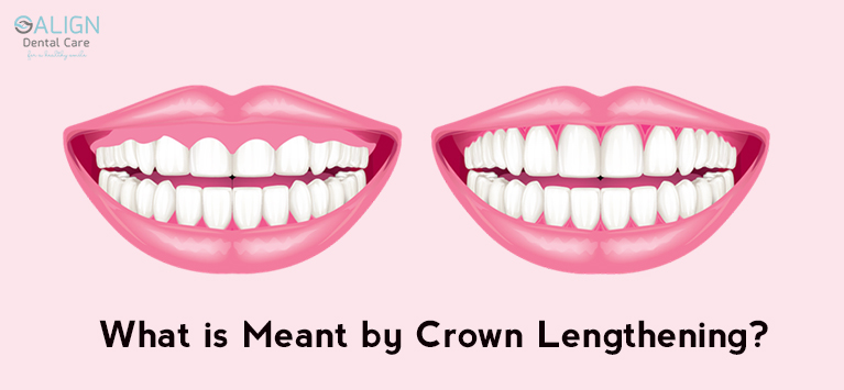 Crown Lengthening