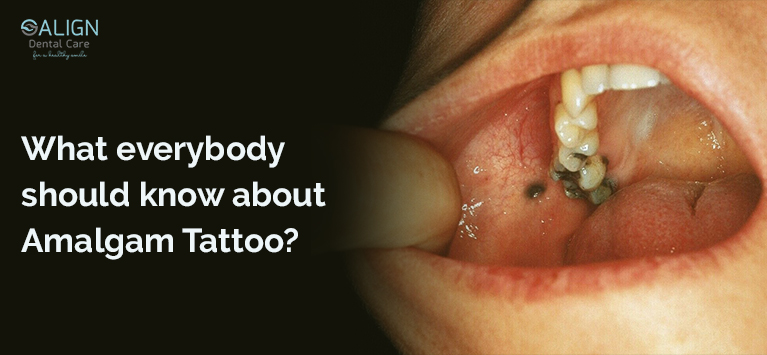 What is meant by Amalgam Tattoo?
