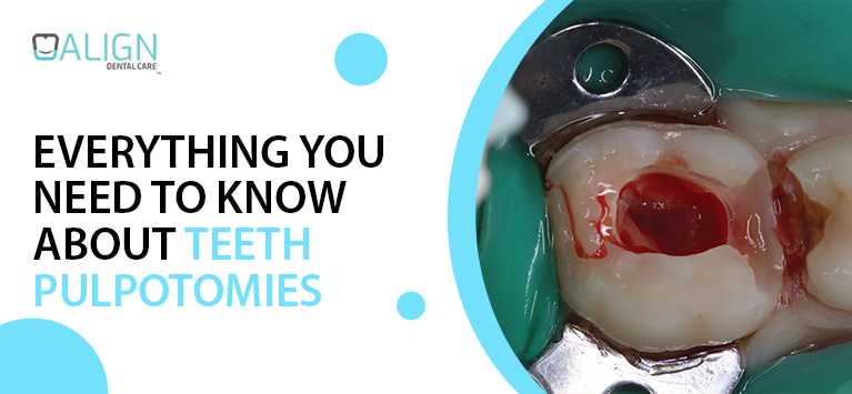 Everything You Need to Know About Teeth Pulpotomies