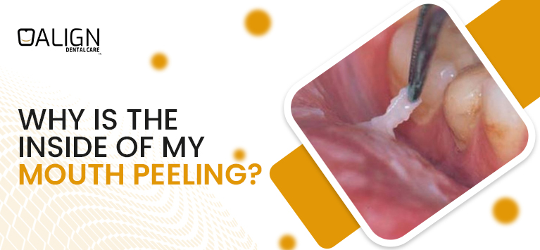 Why is the inside of my mouth peeling?