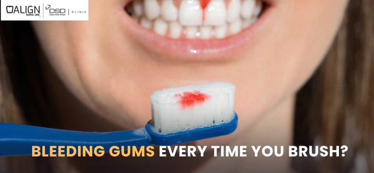 Bleeding Gums Every Time You Brush?