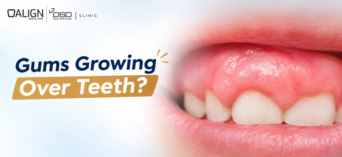 Gums growing over teeth dental awareness poster by Align Dental Care & DSD Clinic showing swollen gums covering the front teeth