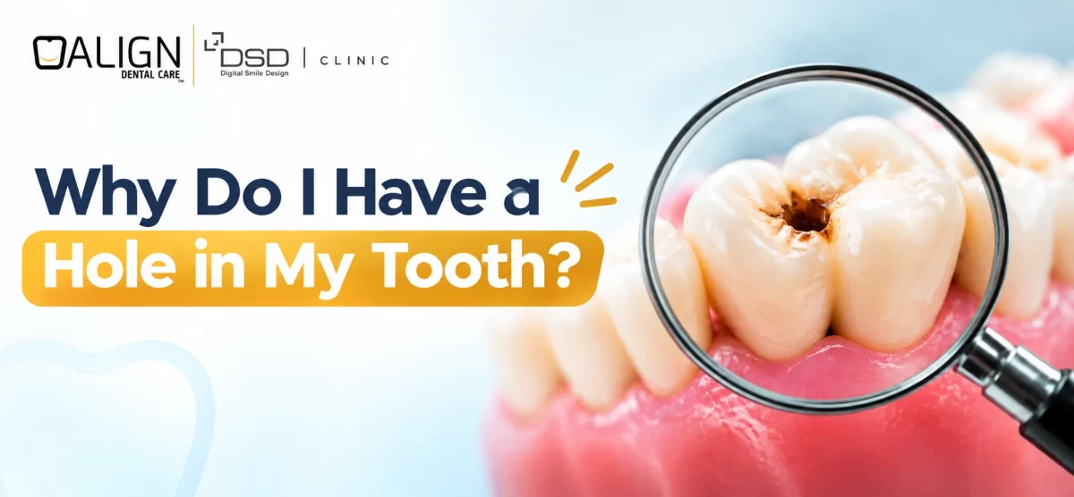 Why Do I Have a Hole in My Tooth? Tooth cavity awareness banner by Align Dental Care, Sri Lanka.